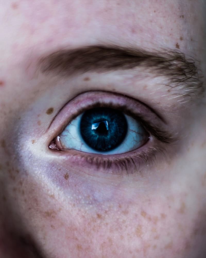 mulher com melasma no olho